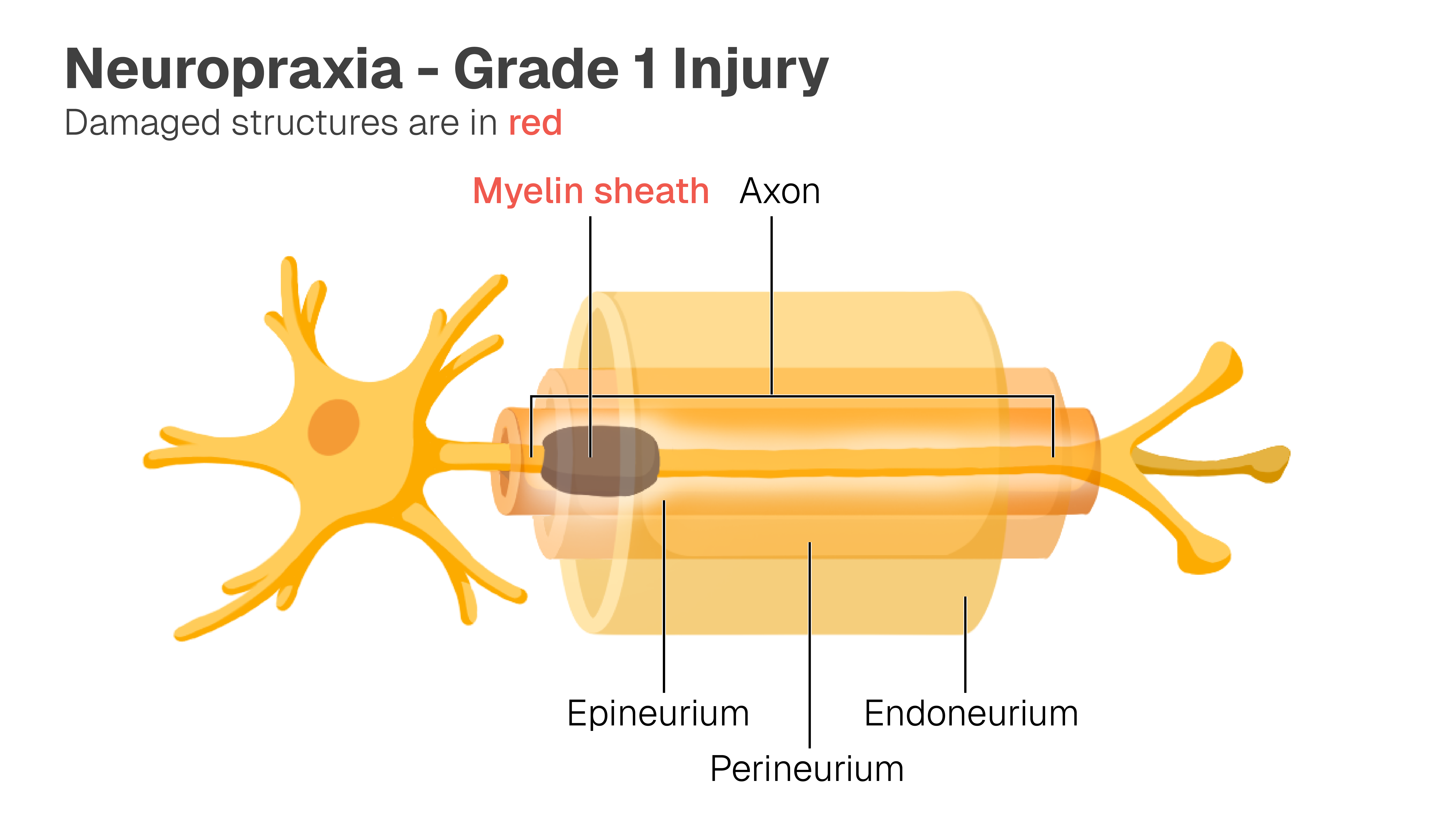 Image of neuron with the myelin sheath, axon, epineurium, perineurium, and endoneurium labelled. The myelin sheath is damaged.